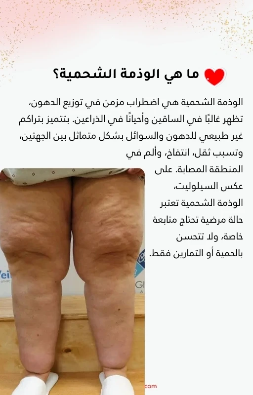 Cellulite & Lipedema, Full Guide
