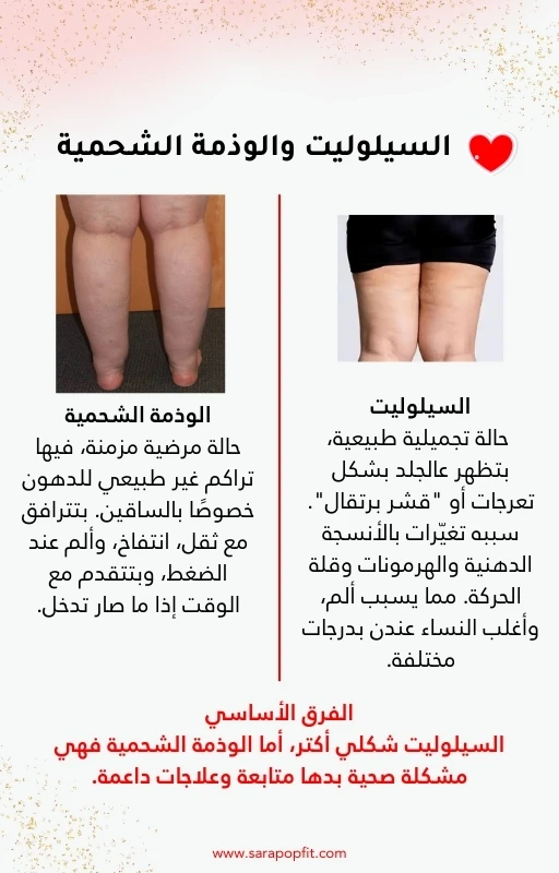 Cellulite & Lipedema, Full Guide