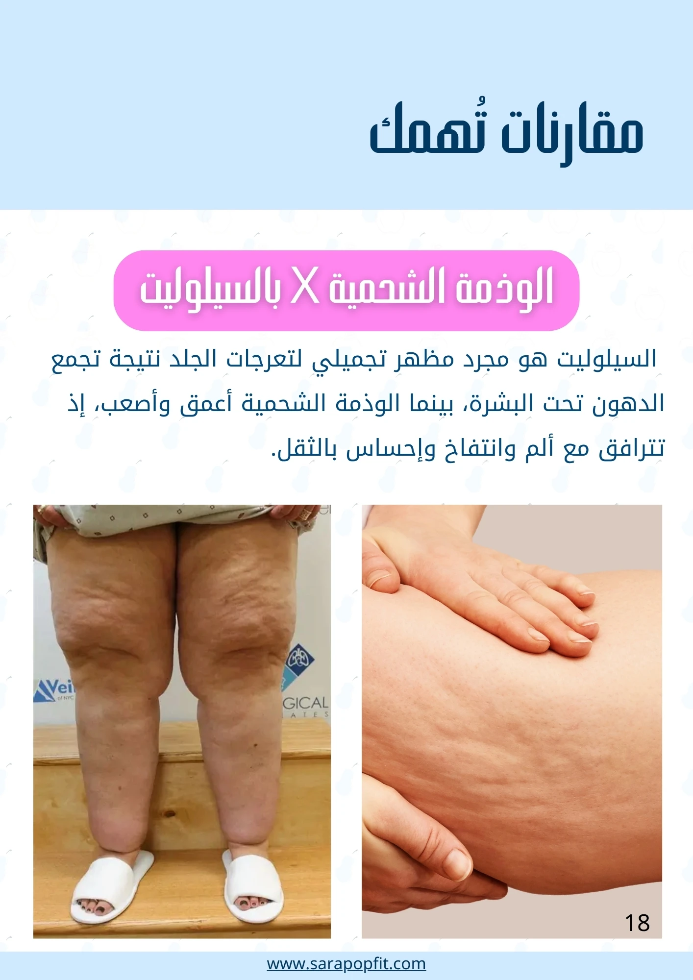 Lipedema Relief – Pear-Shaped Body